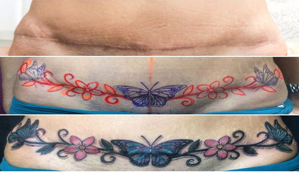 Abdominoplastia antes e depois - foto 4