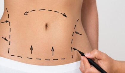 Abdominoplastia: a cirurgia plástica da barriga